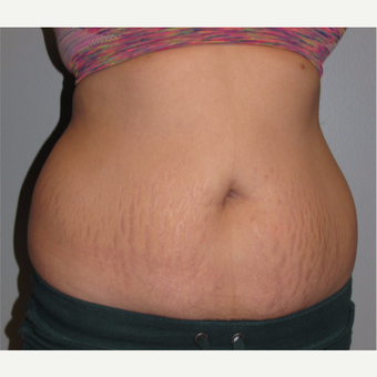 18-24 year old woman treated with Tummy Tuck before 3130512