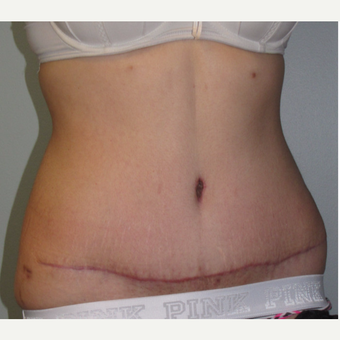 18-24 year old woman treated with Tummy Tuck after 3130512