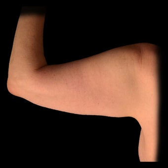 18-24 year old woman treated with Laser Liposuction before 2025446