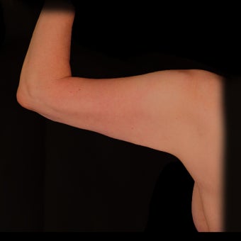 18-24 year old woman treated with Laser Liposuction after 2025446