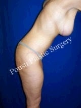 Breast Lift with Implants, Massive Weight Loss, Mommy Makeover, Tummy Tuck (Abdominoplasty) 1094525