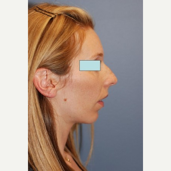 Rhinoplasty before 2990571