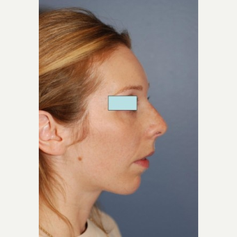 Rhinoplasty after 2990571