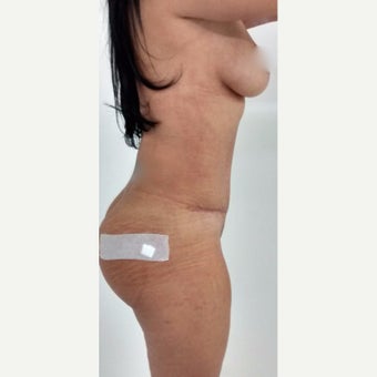 25-34 year old woman treated with Mommy Makeover 1901622
