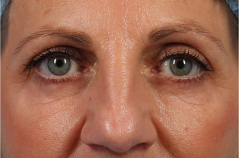 55-64 year old woman treated with surgical eye bags treatment after 2497641