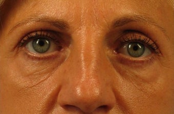 55-64 year old woman treated with surgical eye bags treatment before 2497641