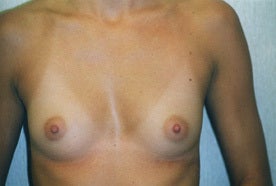 22 year old woman who wants larger breasts with maximum projection. before 1332533