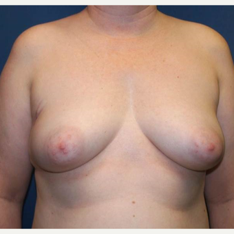 43 year old woman treated with bilateral DIEP flap Reconstruction before 3383438
