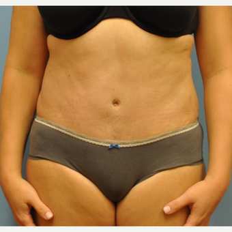33 year old woman treated with Tummy Tuck after 3583966