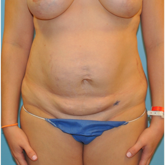 33 year old woman treated with Tummy Tuck before 3583966
