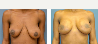 25-34 year old woman treated with Breast Lift with Implants before 3776627