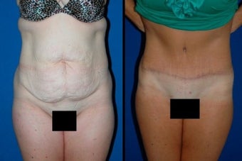 Tummy Tuck before 3037899