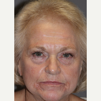 65-74 year old woman treated with Facelift Revision before 3383798
