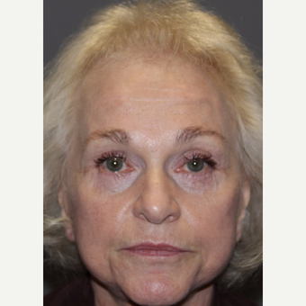65-74 year old woman treated with Facelift Revision after 3383798