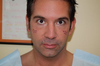 Before and After Radiesse Injections to the Cheeks and Jaw Line. before 302623