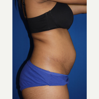 Tummy Tuck before 3743917