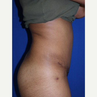 Tummy Tuck after 3743917