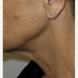 45-54 year old woman treated with Facelift before 3500855