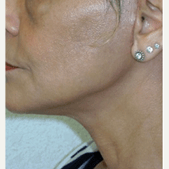 45-54 year old woman treated with Facelift after 3500855