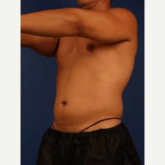 Liposuction before 3743846