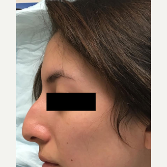 18-24 year old woman treated with Nose Surgery before 3809199
