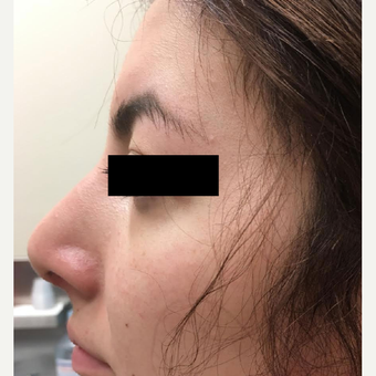 18-24 year old woman treated with Nose Surgery after 3809199