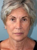 65-74 year old woman treated with Neck Lift before 3103958