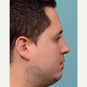 25-34 year old man treated with Revision septoplasty/Rhinoplasty with rib graft before 3092793