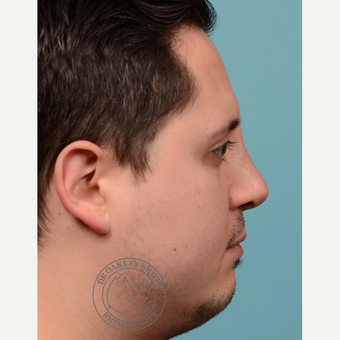 25-34 year old man treated with Revision septoplasty/Rhinoplasty with rib graft after 3092793