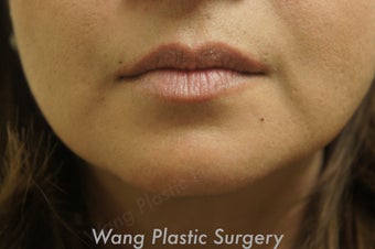 Juvederm to improve marionette lines before 693347