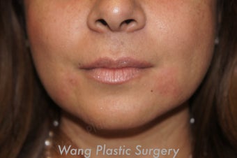 Juvederm to improve marionette lines after 693347