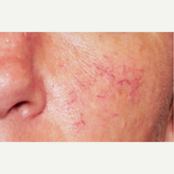 45-54 year old man treated with V Beam before 3141912