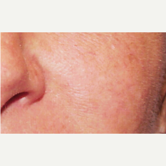 45-54 year old man treated with V Beam after 3141912