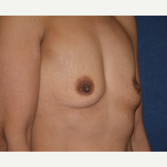 45-54 year old woman treated with Breast Implants before 3454908