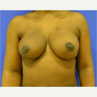 35-44 year old woman treated with Breast Reduction and lymph node transfer after 3731022