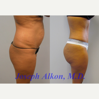 35-44 year old woman treated with Brazilian Butt Lift before 2781705
