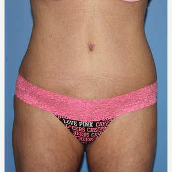 45-54 year old woman treated with Liposuction after 3069717
