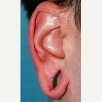 18-24 year old man treated with Ear Lobe Surgery before 2573411