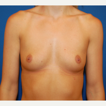 25-34 year old woman treated with Breast Augmentation before 3611951