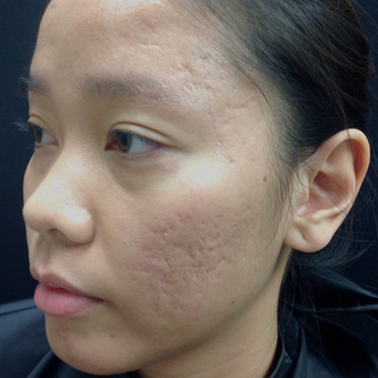 25-34 year old woman treated with Microneedling before 3844409