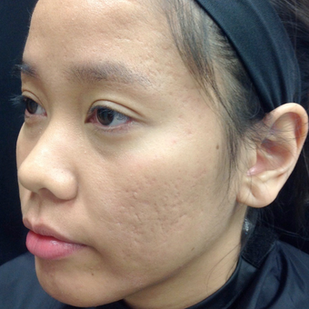 25-34 year old woman treated with Microneedling after 3844409