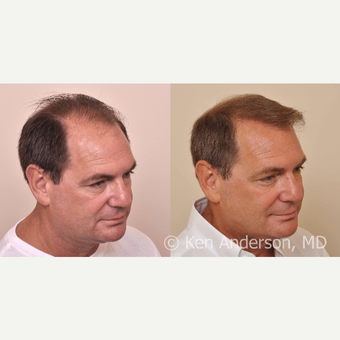 57yo man - ARTAS Robotic Hair Transplant, and PRP with ACell after 3008928