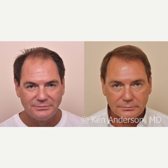 57yo man - ARTAS Robotic Hair Transplant, and PRP with ACell before 3008928