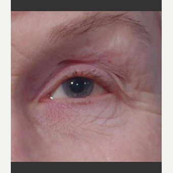 55-64 year old woman treated with Laser Treatment before 3711036