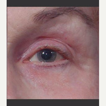 55-64 year old woman treated with Laser Treatment after 3711036