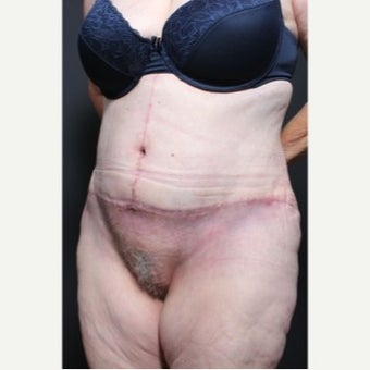45-54 year old woman treated with Weight Loss 1957227