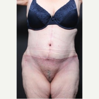 45-54 year old woman treated with Weight Loss after 1957227