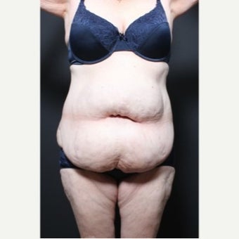 45-54 year old woman treated with Weight Loss before 1957227
