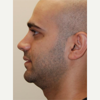18-24 year old man treated with Rhinoplasty after 3143611