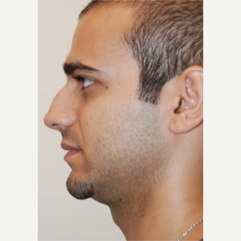 18-24 year old man treated with Rhinoplasty before 3143611